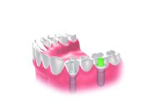 Oral health with implants
