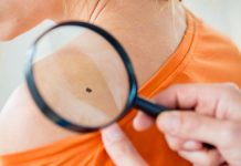 Ground-breaking melanoma study