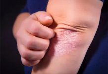 Clinical trial of experimental new treatment
for chronic plaque psoriasis